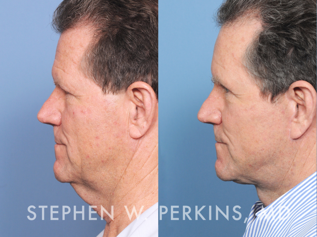 Indianapolis Facial Plastic Surgeons | Dr. Stephen Perkins, MD 24_EV