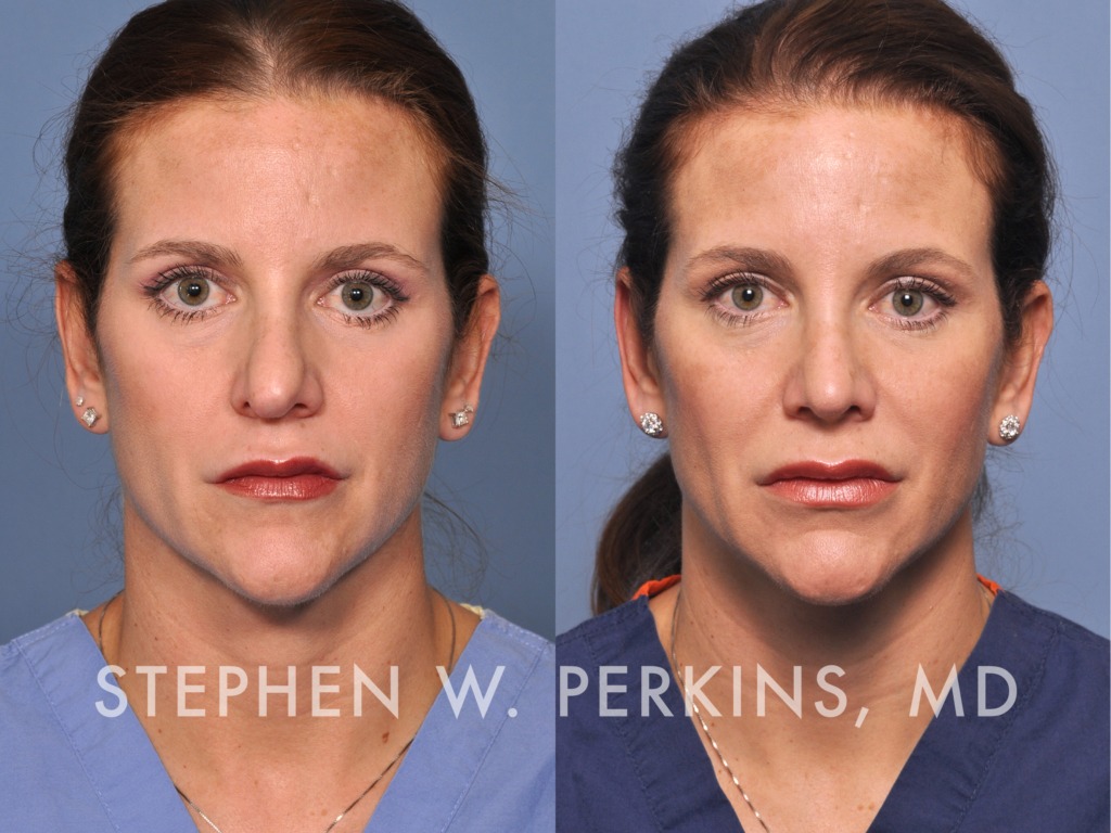 Indianapolis Plastic Surgeons | Dr. Stephen Perkins, MD 01