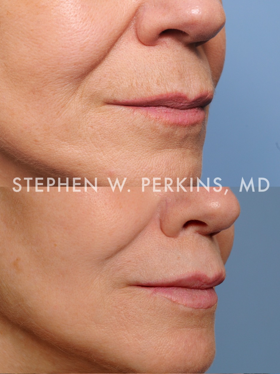 Lip Enhancement Indianapolis Facial Plastic Surgeons Dr. Stephen