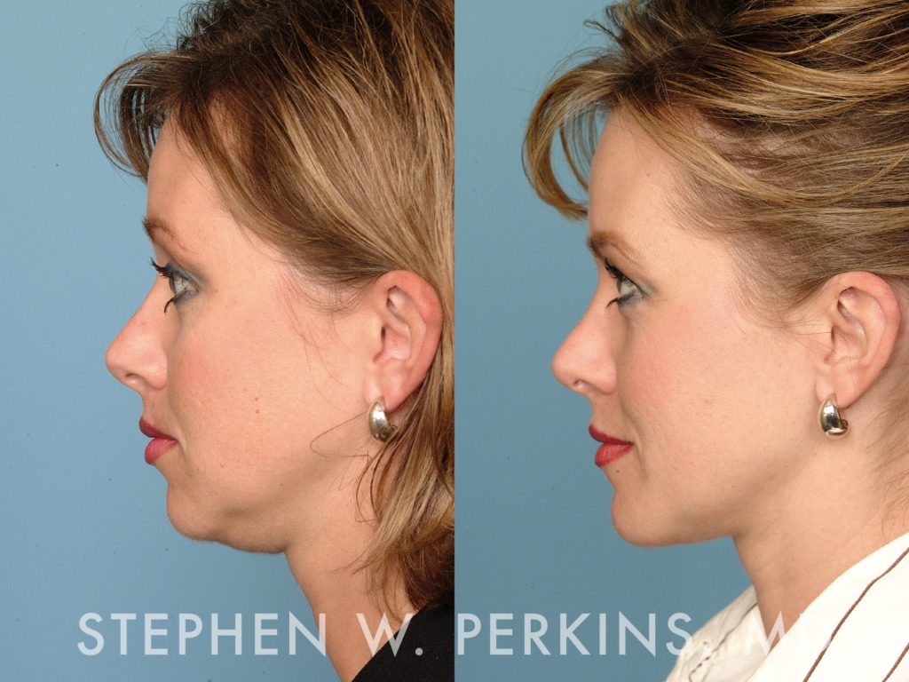 Indianapolis Facial Plastic Surgeons | Dr. Stephen Perkins, MD 03