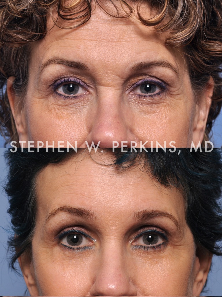 Indianapolis Facial Plastic Surgeons | Dr. Stephen Perkins, MD 03b