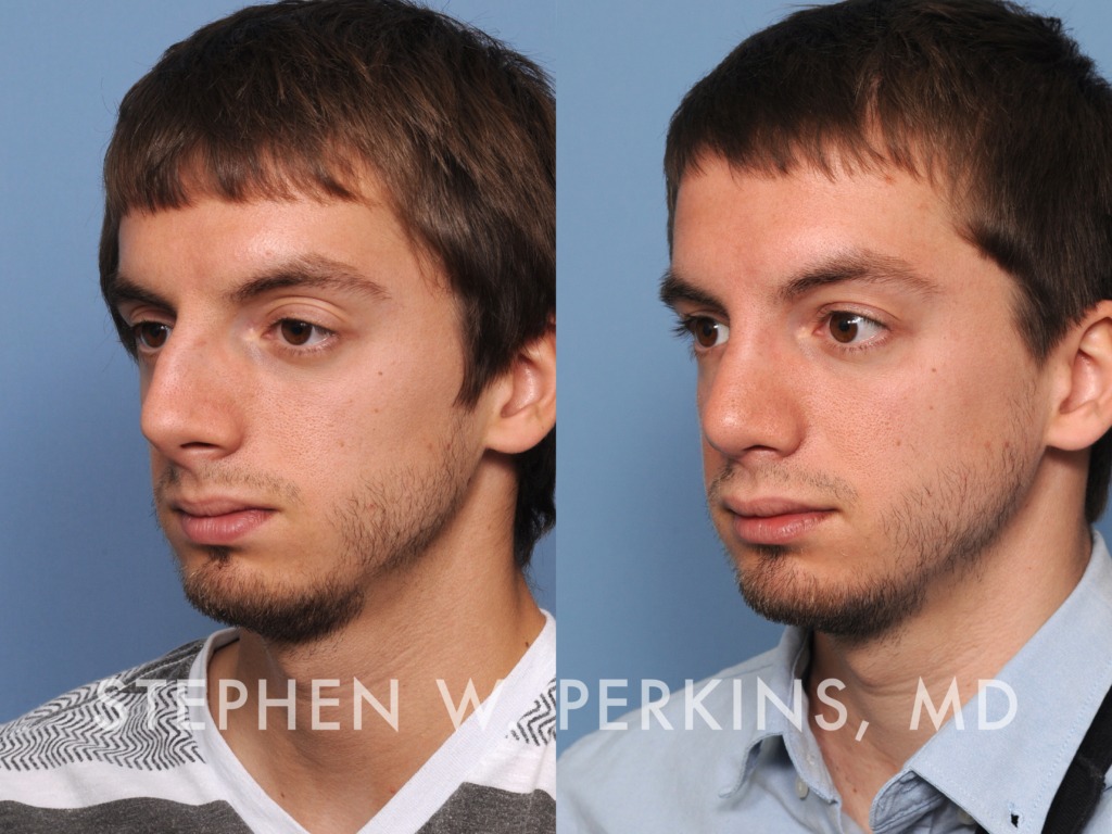 Indianapolis Facial Plastic Surgeons | Dr. Stephen Perkins, MD 04