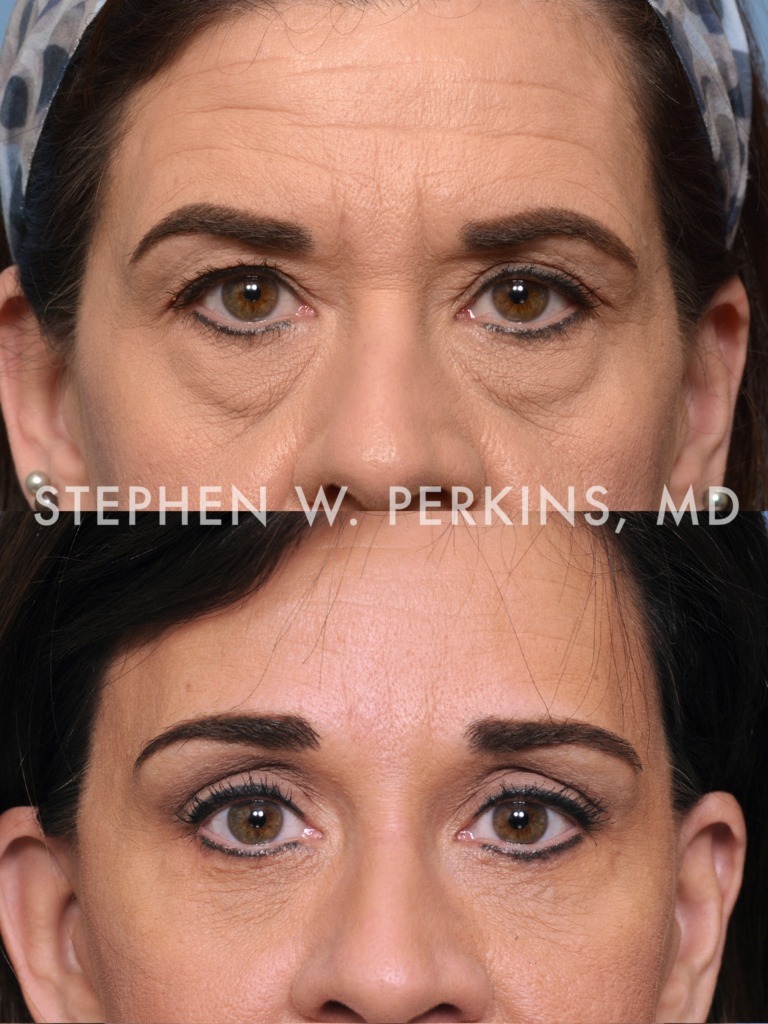 Indianapolis Facial Plastic Surgeons | Dr. Stephen Perkins, MD 04b