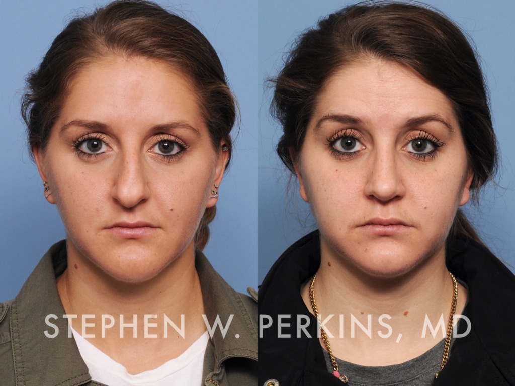 Indianapolis Facial Plastic Surgeons | Dr. Stephen Perkins, MD 05