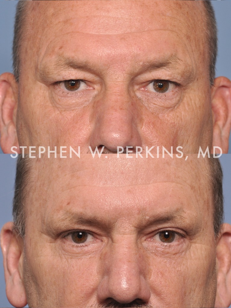 Indianapolis Facial Plastic Surgeons | Dr. Stephen Perkins, MD 05b_