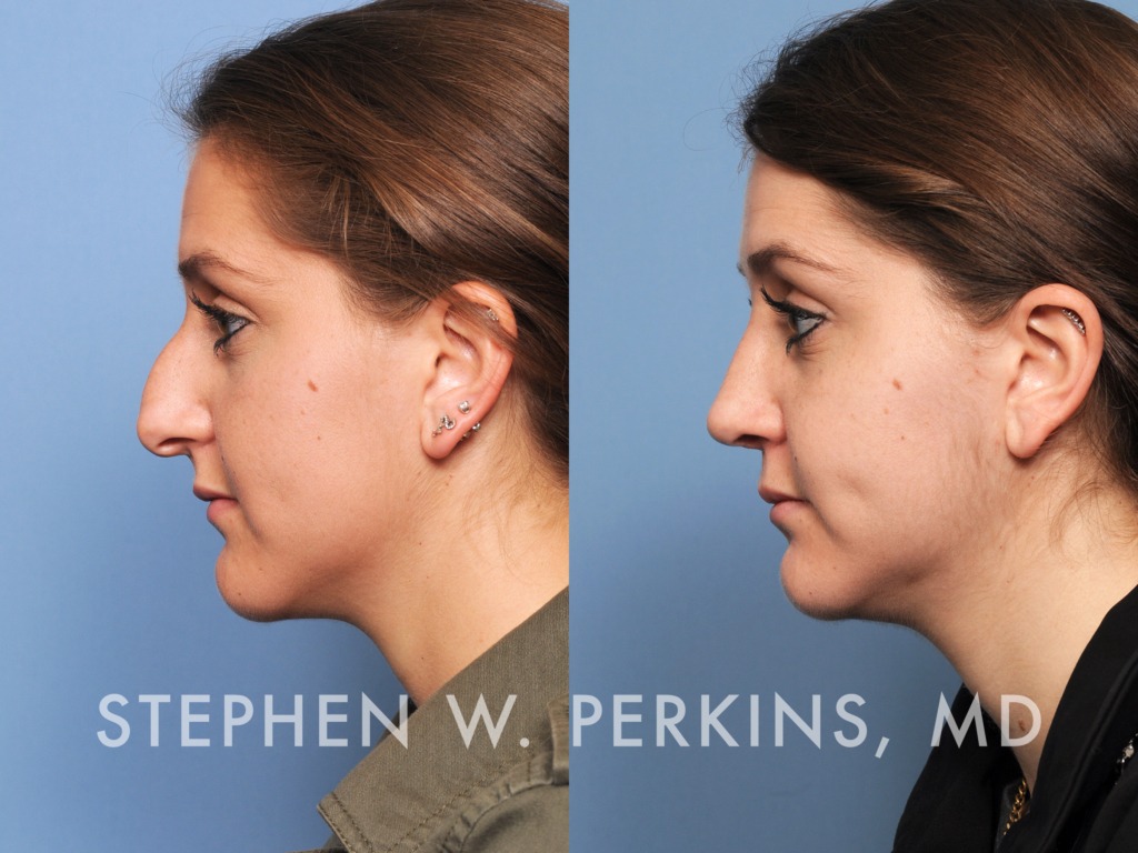 Indianapolis Facial Plastic Surgeons | Dr. Stephen Perkins, MD 06