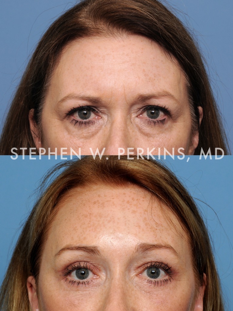 Indianapolis Facial Plastic Surgeons | Dr. Stephen Perkins, MD 08b_GA