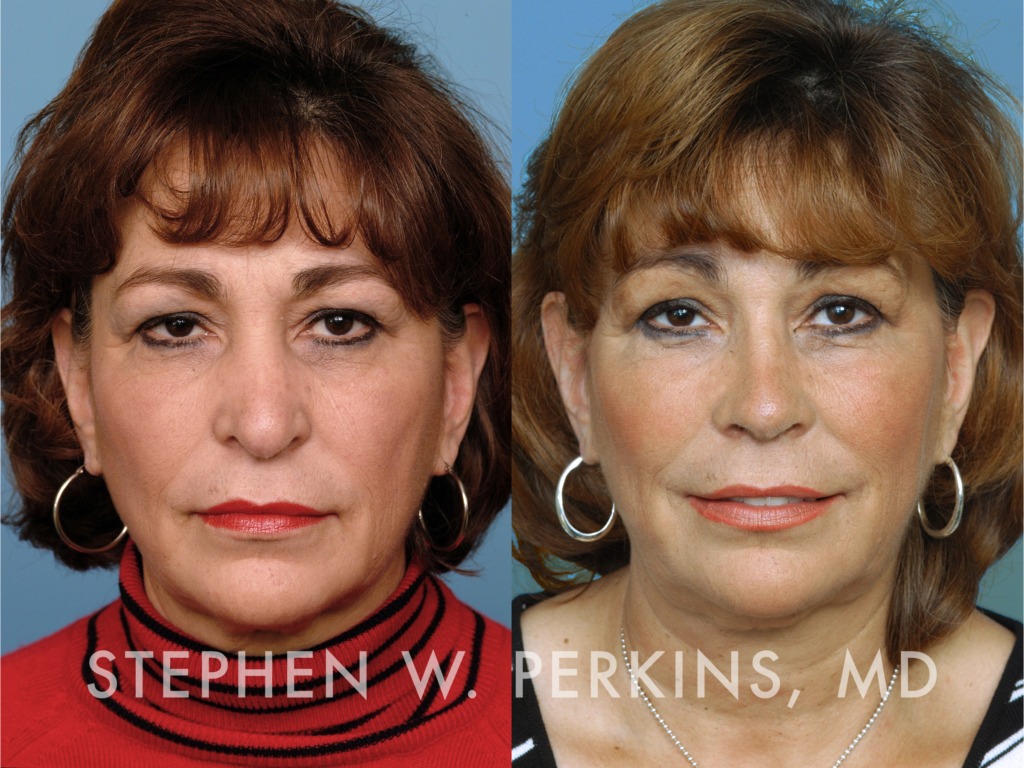 Indianapolis Facial Plastic Surgeons | Dr. Stephen Perkins, MD 09