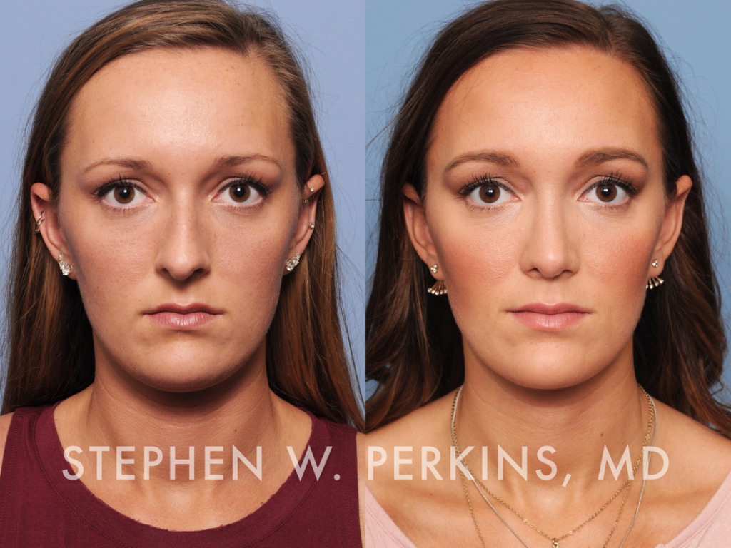 Indianapolis Facial Plastic Surgeons | Dr. Stephen Perkins, MD 11
