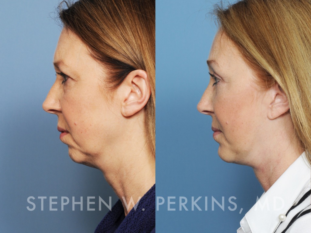 Indianapolis Facial Plastic Surgeons | Dr. Stephen Perkins, MD 11_GA2