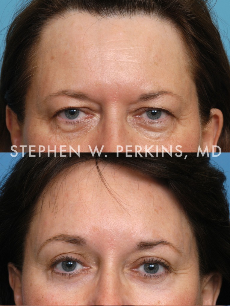 Indianapolis Facial Plastic Surgeons | Dr. Stephen Perkins, MD 11b