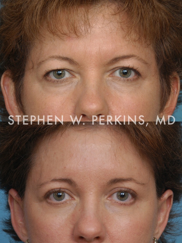 Indianapolis Facial Plastic Surgeons | Dr. Stephen Perkins, MD 13b