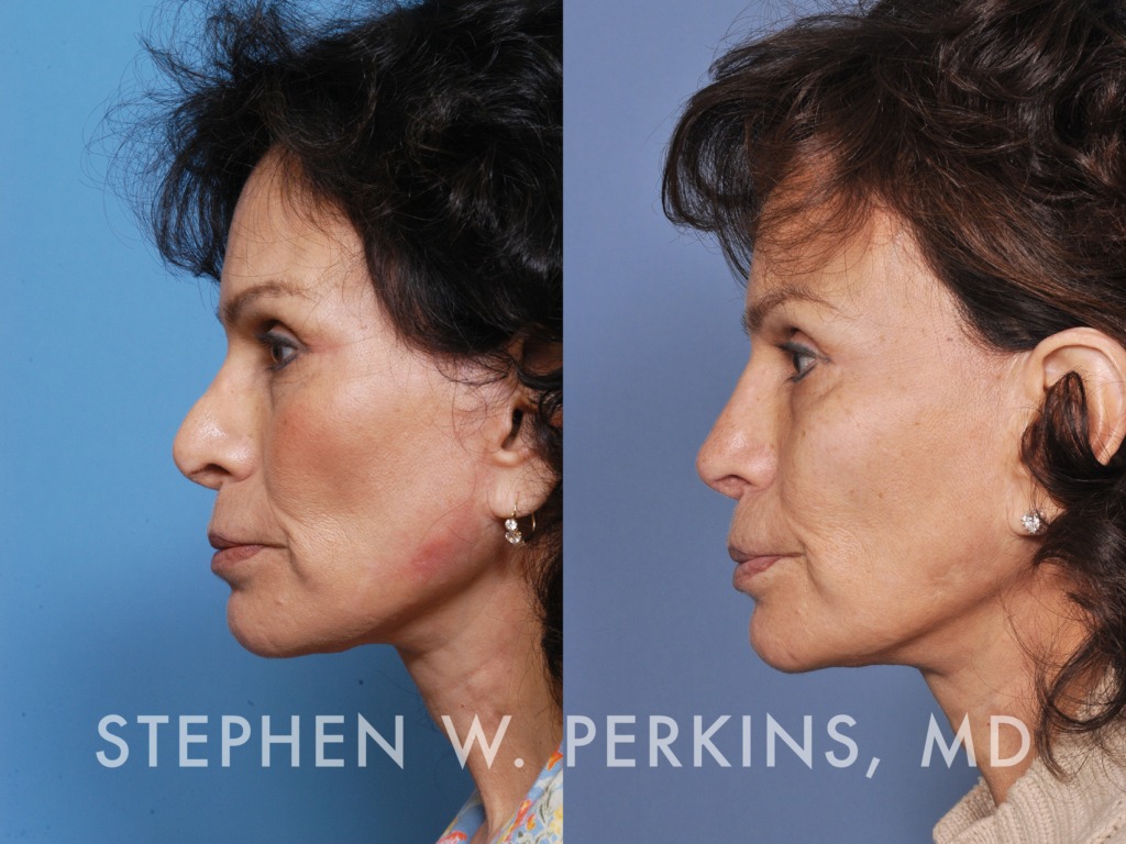 Indianapolis Facial Plastic Surgeons | Dr. Stephen Perkins, MD 15