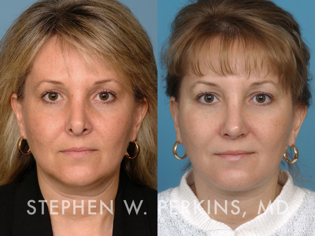 Indianapolis Facial Plastic Surgeons | Dr. Stephen Perkins, MD 16