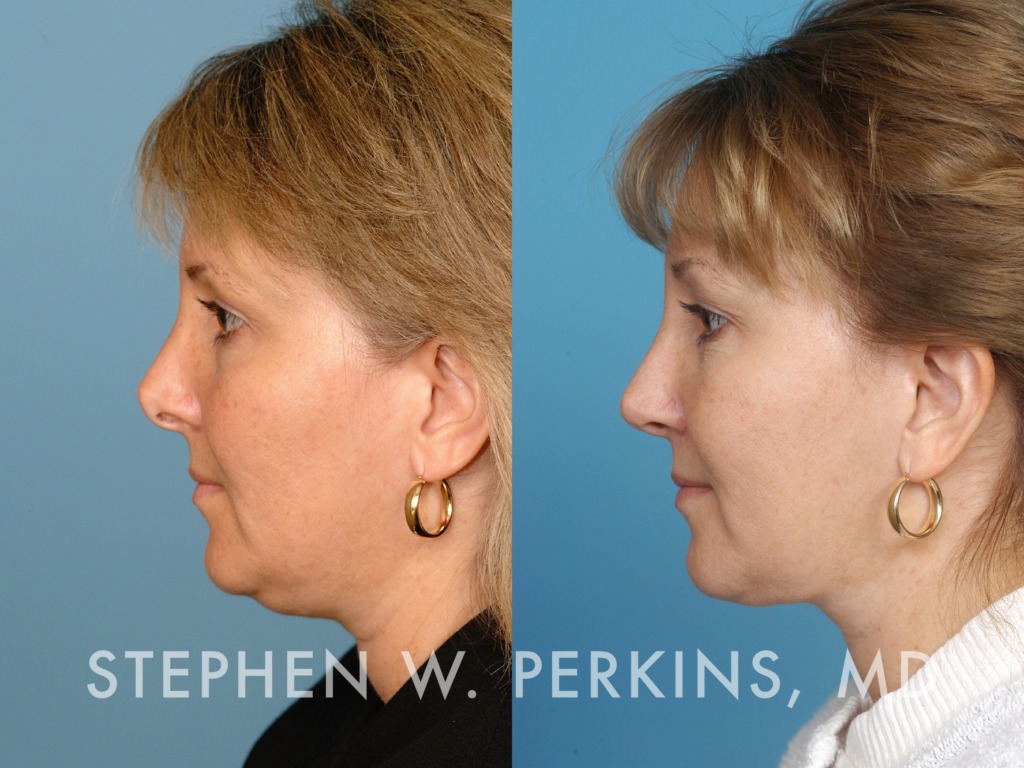 Indianapolis Facial Plastic Surgeons | Dr. Stephen Perkins, MD 17