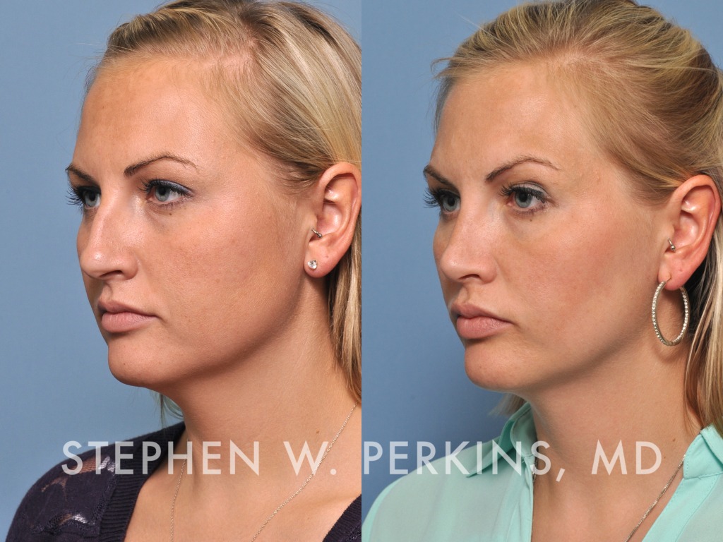 Indianapolis Facial Plastic Surgeons | Dr. Stephen Perkins, MD 18