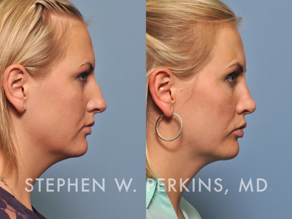 Indianapolis Facial Plastic Surgeons | Dr. Stephen Perkins, MD 19
