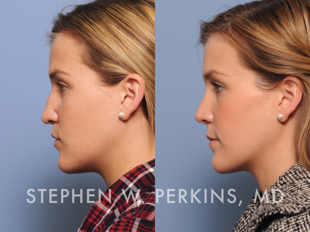 Indianapolis Facial Plastic Surgeons | Dr. Stephen Perkins, MD 21