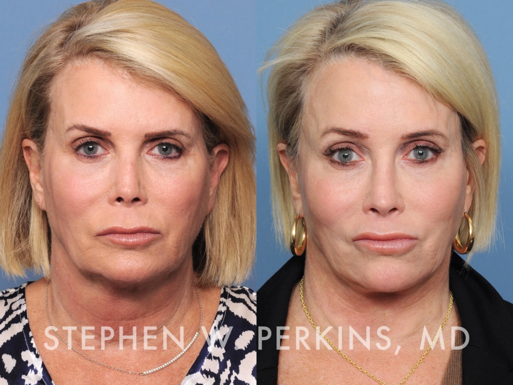Indianapolis Facial Plastic Surgeons | Dr. Stephen Perkins, MD 23