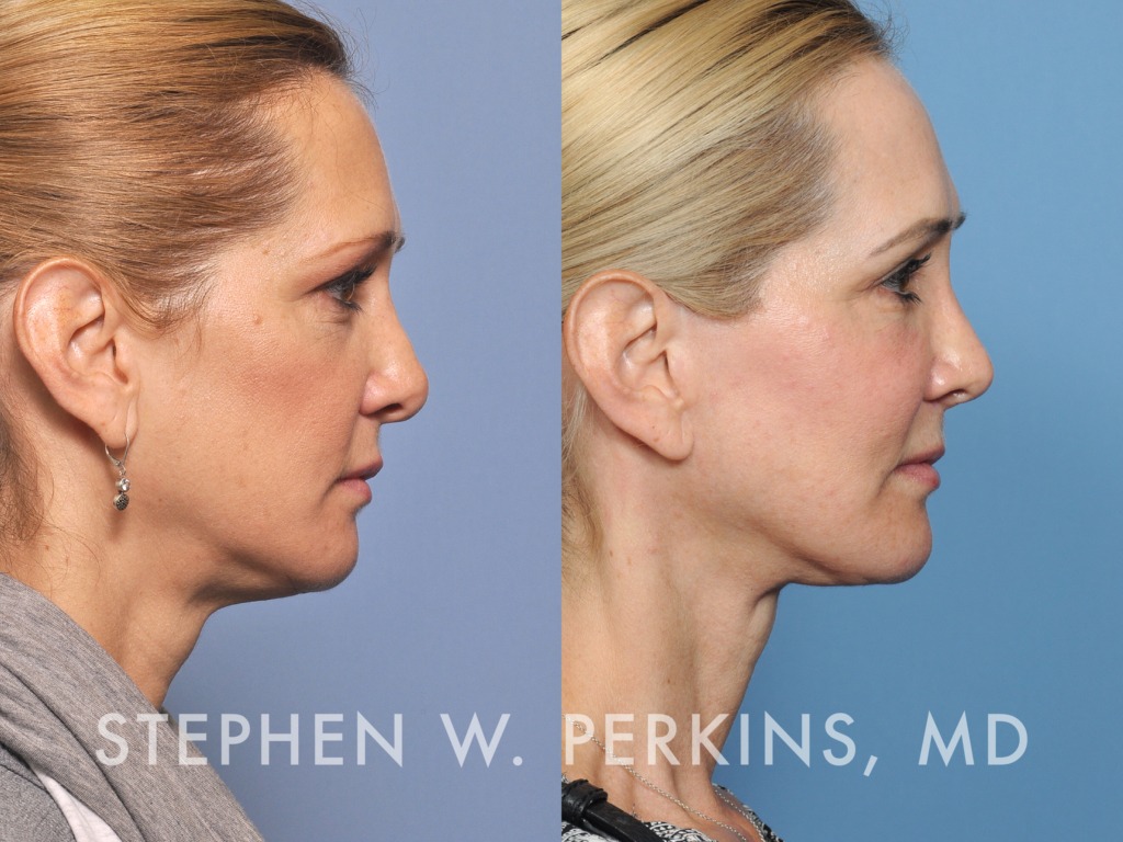 Indianapolis Facial Plastic Surgeons | Dr. Stephen Perkins, MD 27