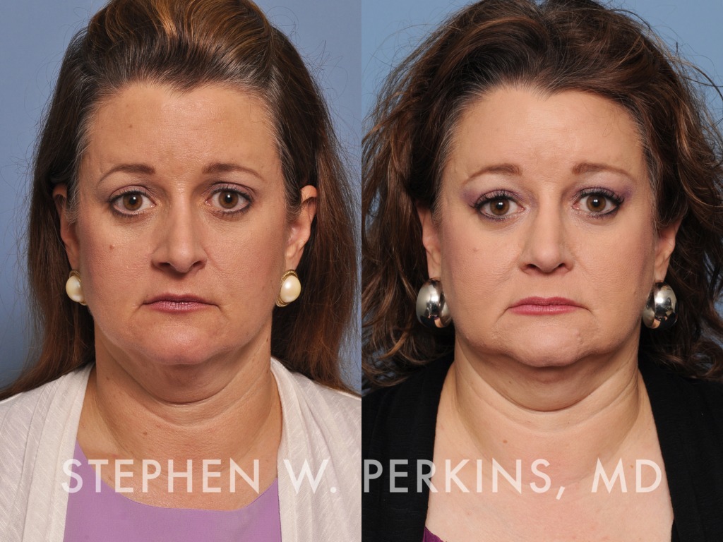 Indianapolis Plastic Surgeons | Dr. Stephen Perkins, MD 28