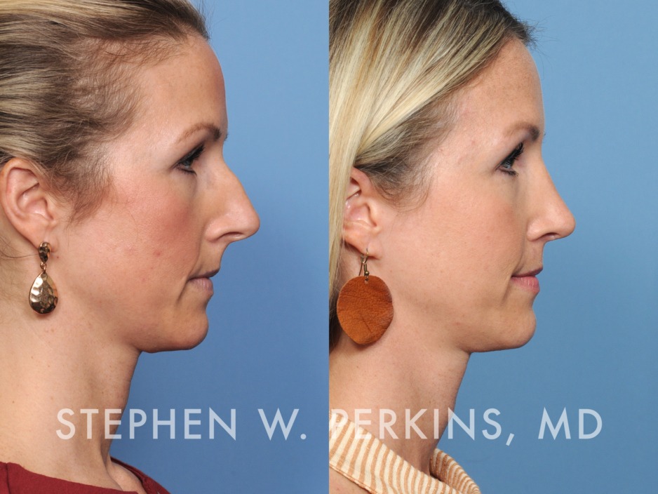 Rhinoplasty Indianapolis Facial Plastic Surgeons Dr. Stephen