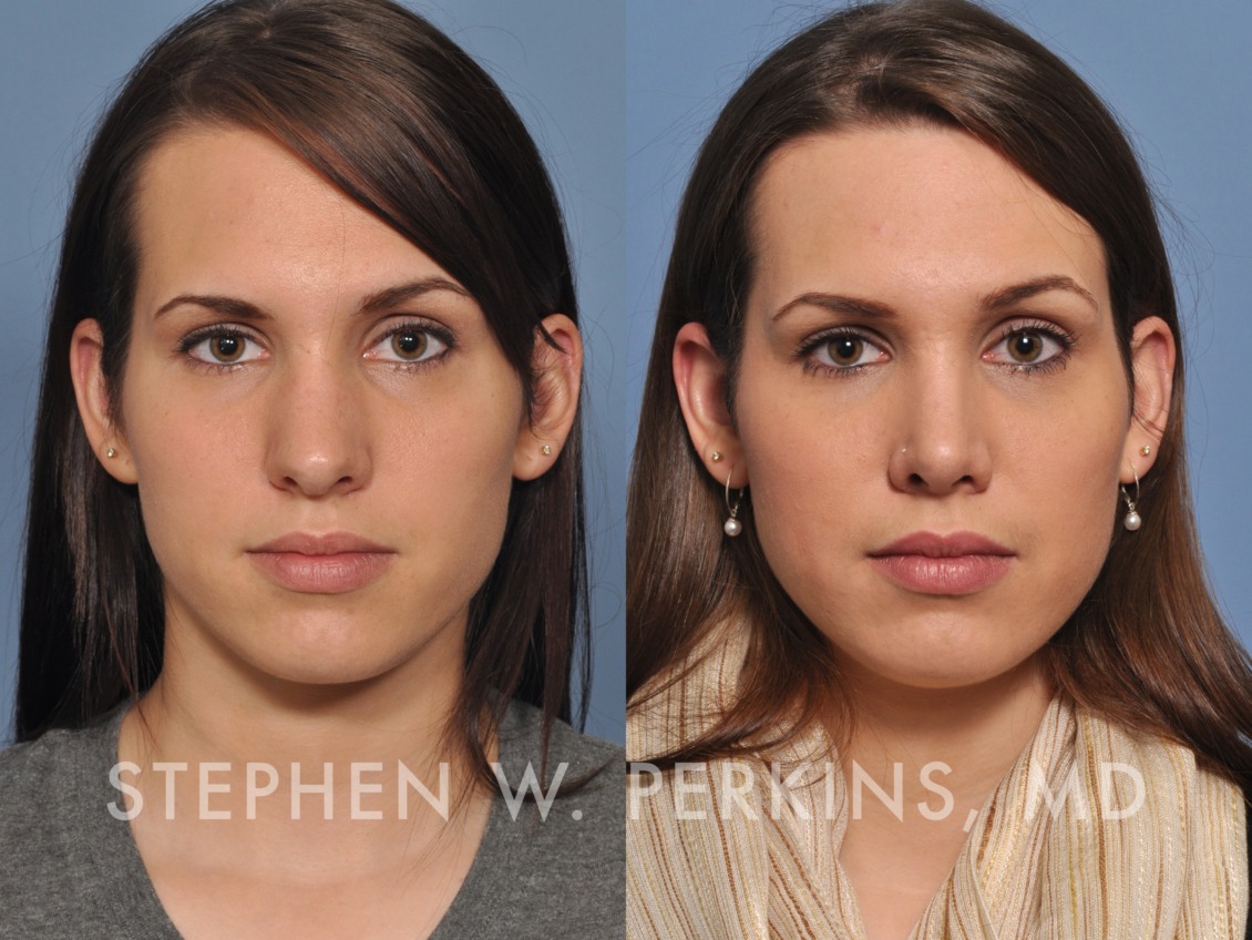 Christine Indianapolis Facial Plastic Surgeons Dr. Stephen Perkins, MD