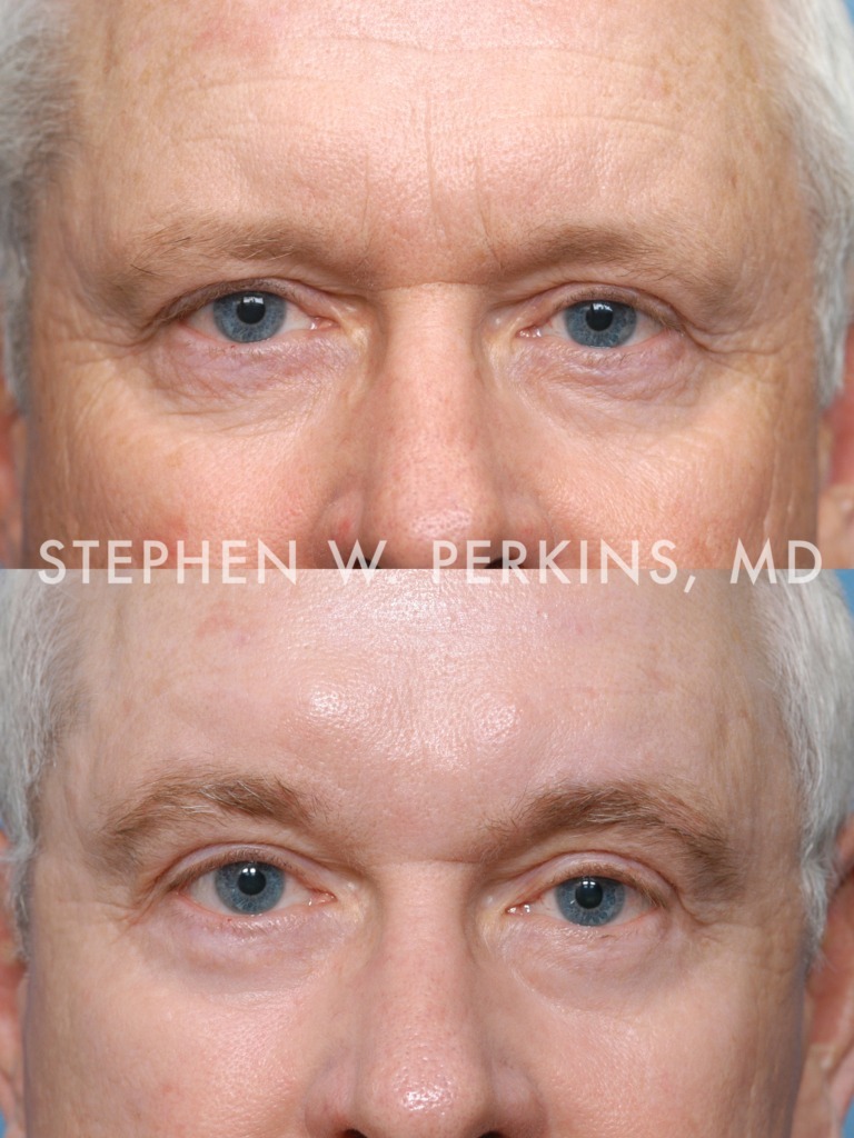 Indianapolis Facial Plastic Surgeons | Dr. Stephen Perkins, MD 02WD