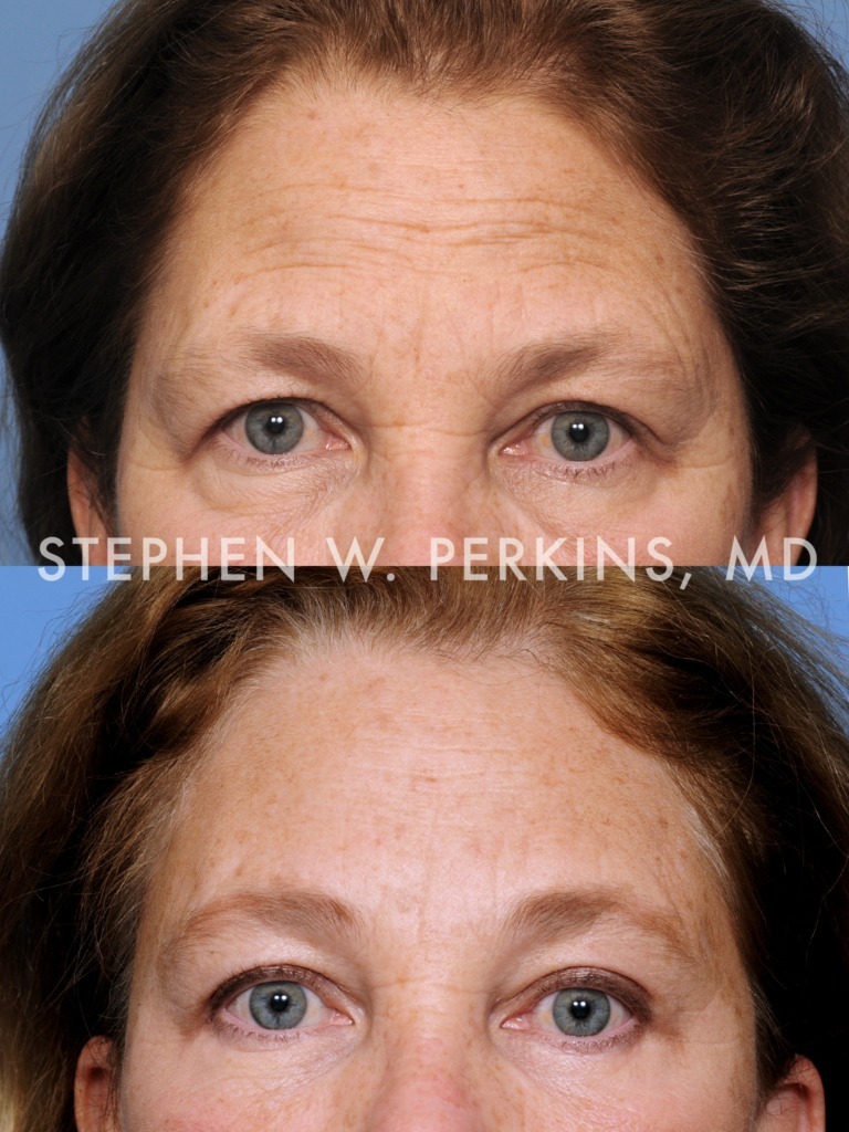 Indianapolis Facial Plastic Surgeons | Dr. Stephen Perkins, MD 04JK