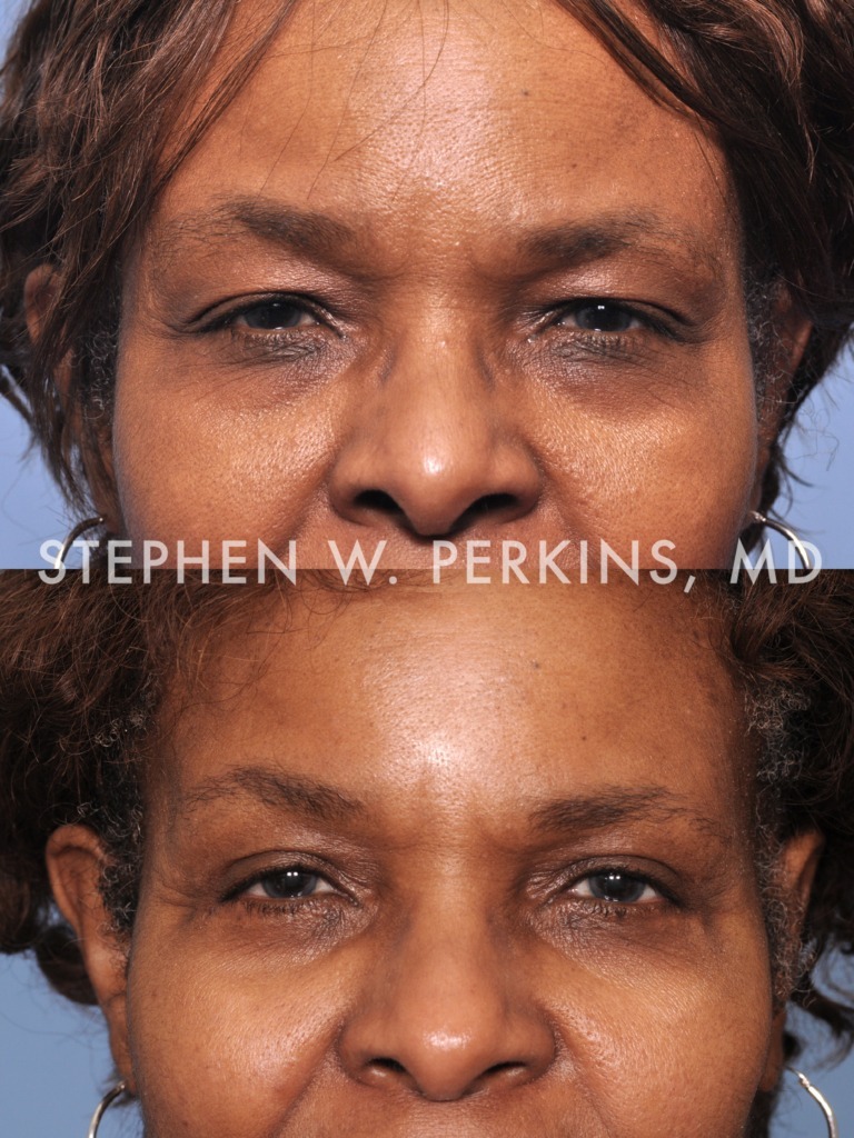 Indianapolis Facial Plastic Surgeons | Dr. Stephen Perkins, MD 05VF