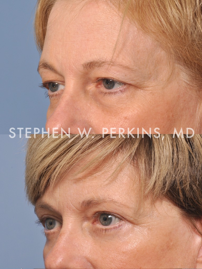 Indianapolis Facial Plastic Surgeons | Dr. Stephen Perkins, MD 06SH