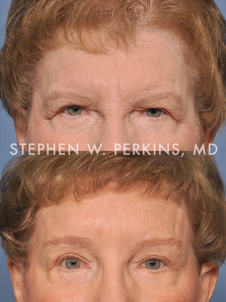 Indianapolis Facial Plastic Surgeons | Dr. Stephen Perkins, MD 09PR