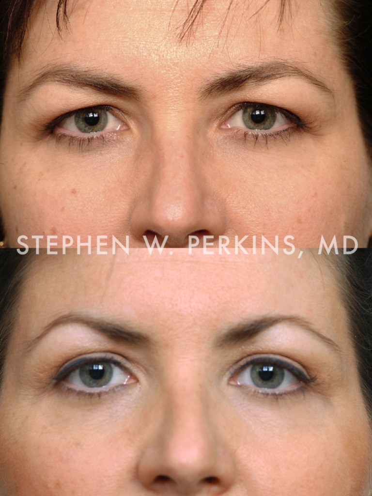 Indianapolis Facial Plastic Surgeons | Dr. Stephen Perkins, MD 11NR