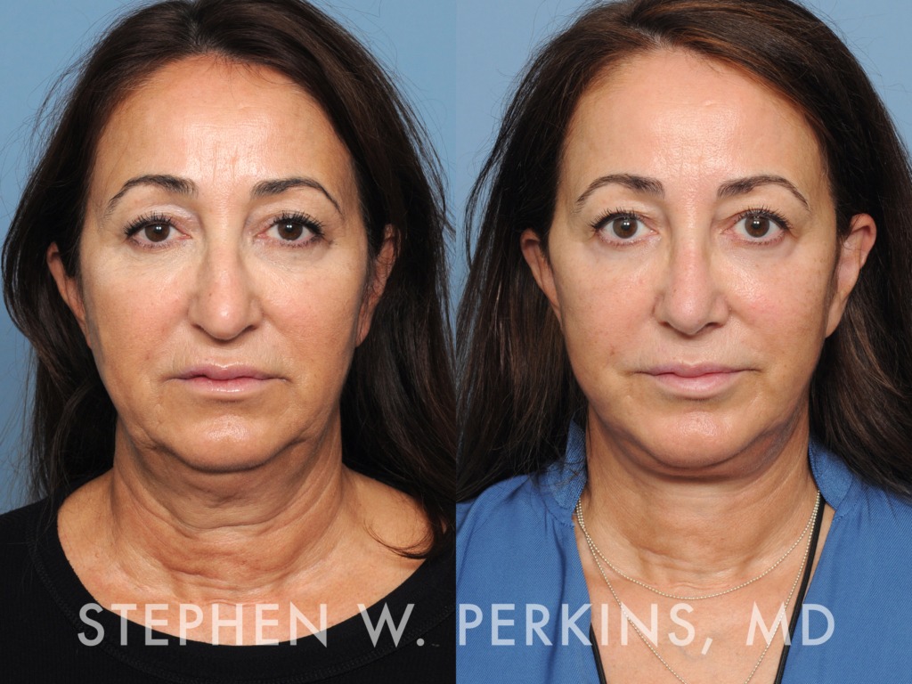 Indianapolis Facial Plastic Surgeons | Dr. Stephen Perkins, MD 19MW