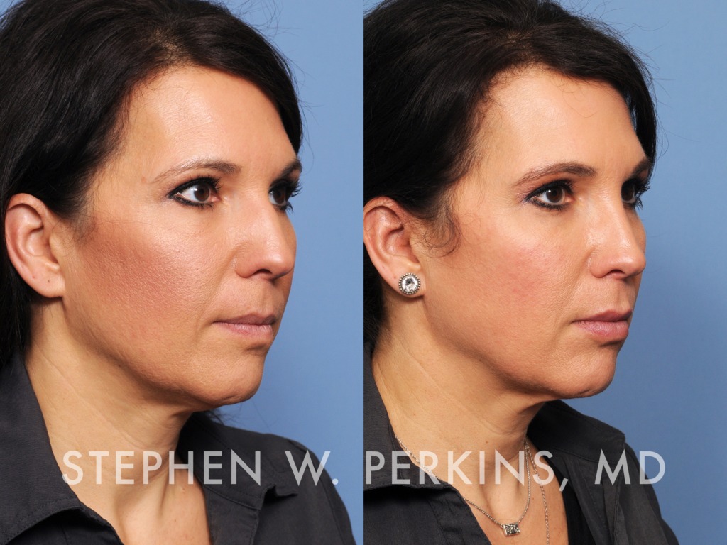 Indianapolis Facial Plastic Surgeons | Dr. Stephen Perkins, MD 31