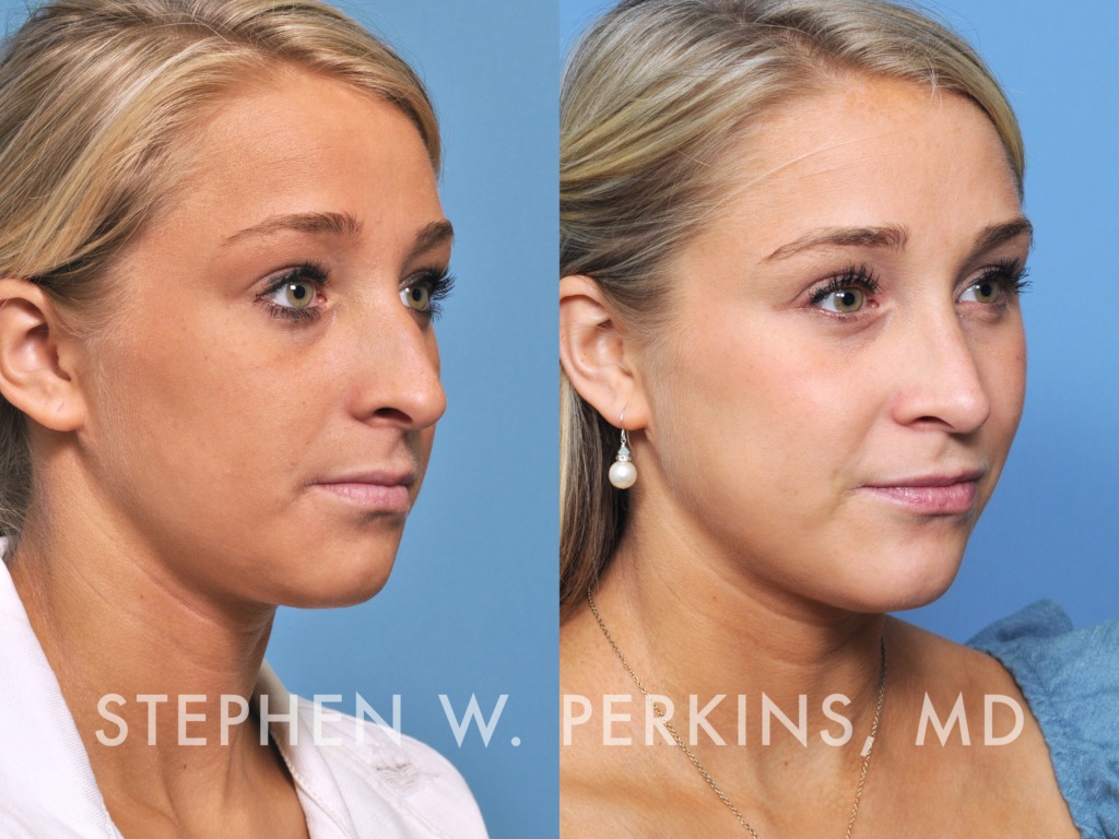 Indianapolis Facial Plastic Surgeons | Dr. Stephen Perkins, MD 33