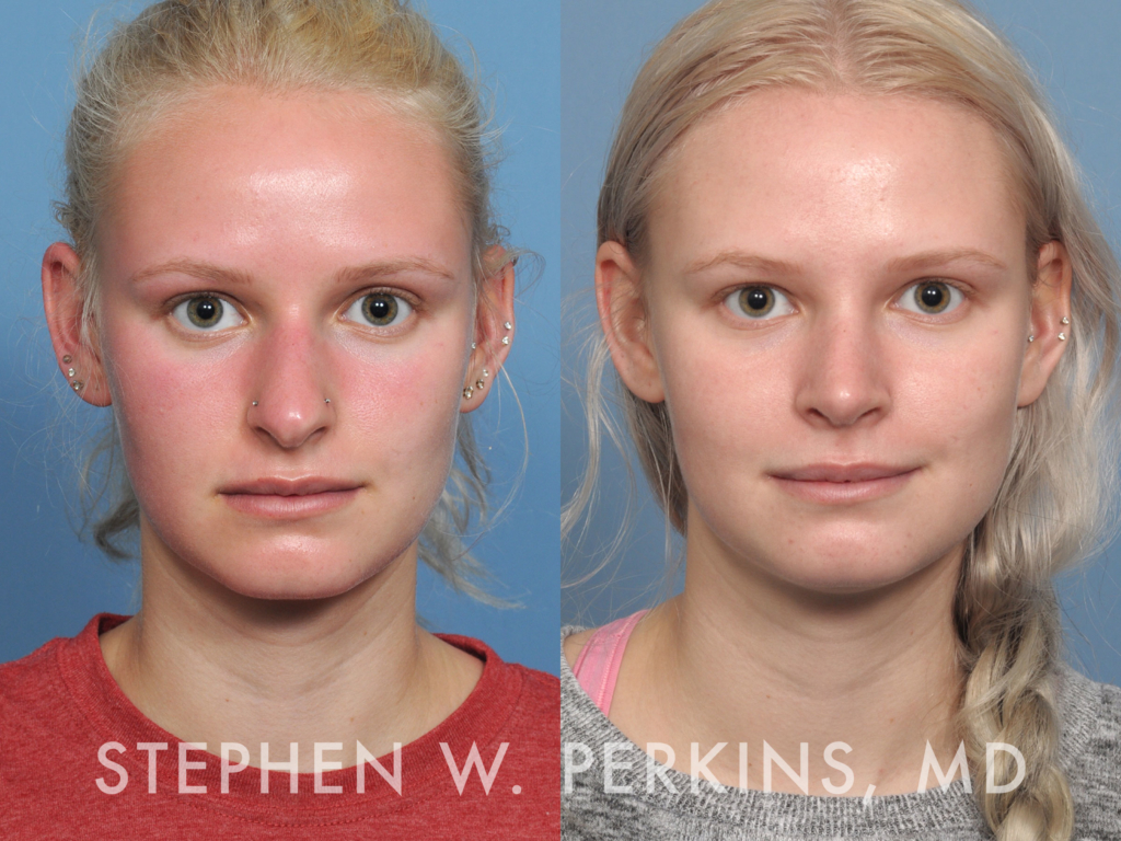 Indianapolis Facial Plastic Surgeons | Dr. Stephen Perkins, MD 45_ES