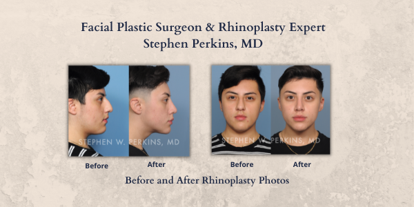 View Dr. Stephen Perkins Actual Before and After Rhinoplasty Photos