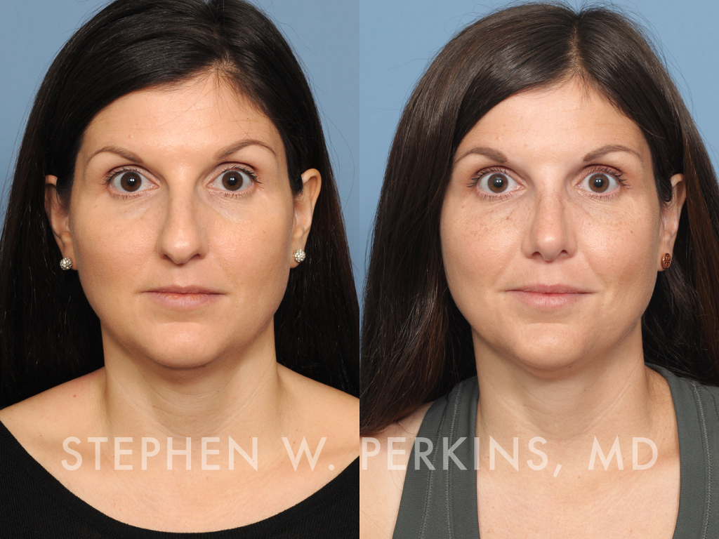 Indianapolis Facial Plastic Surgeons | Dr. Stephen Perkins, MD DL15