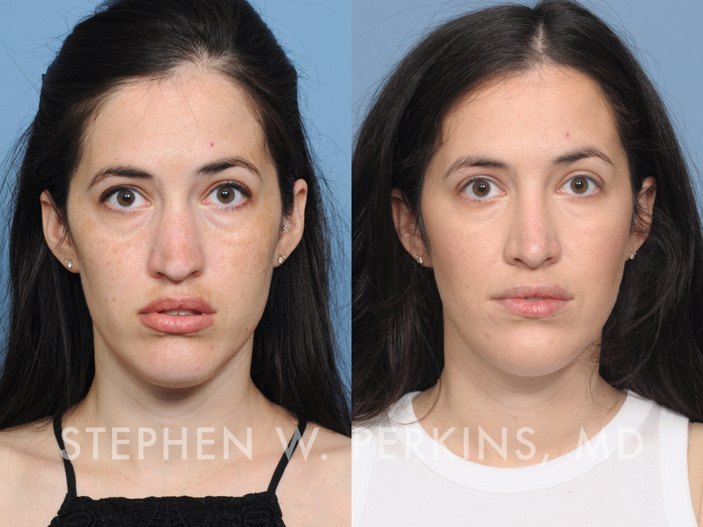 Indianapolis Facial Plastic Surgeons | Dr. Stephen Perkins, MD JF12