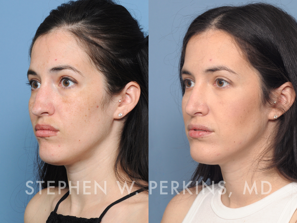 Indianapolis Facial Plastic Surgeons | Dr. Stephen Perkins, MD JF13