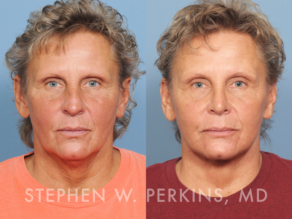 Indianapolis Facial Plastic Surgeons | Dr. Stephen Perkins, MD LN19-1