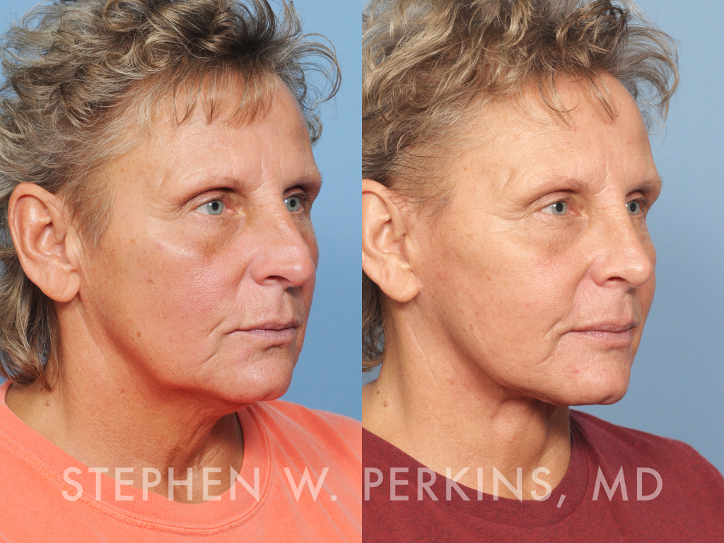Indianapolis Facial Plastic Surgeons | Dr. Stephen Perkins, MD LN22-1