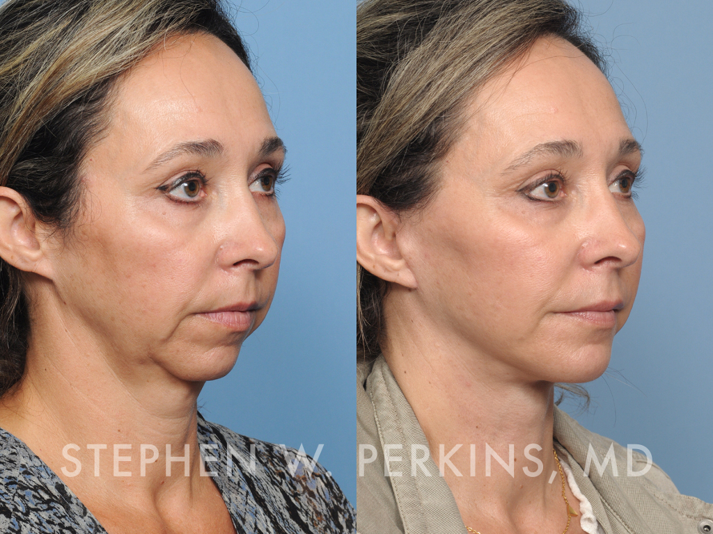 Indianapolis Facial Plastic Surgeons | Dr. Stephen Perkins, MD QH02-angle-1