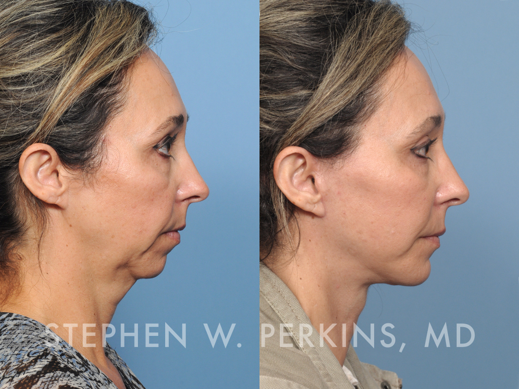 Indianapolis Facial Plastic Surgeons | Dr. Stephen Perkins, MD QH03-side-1