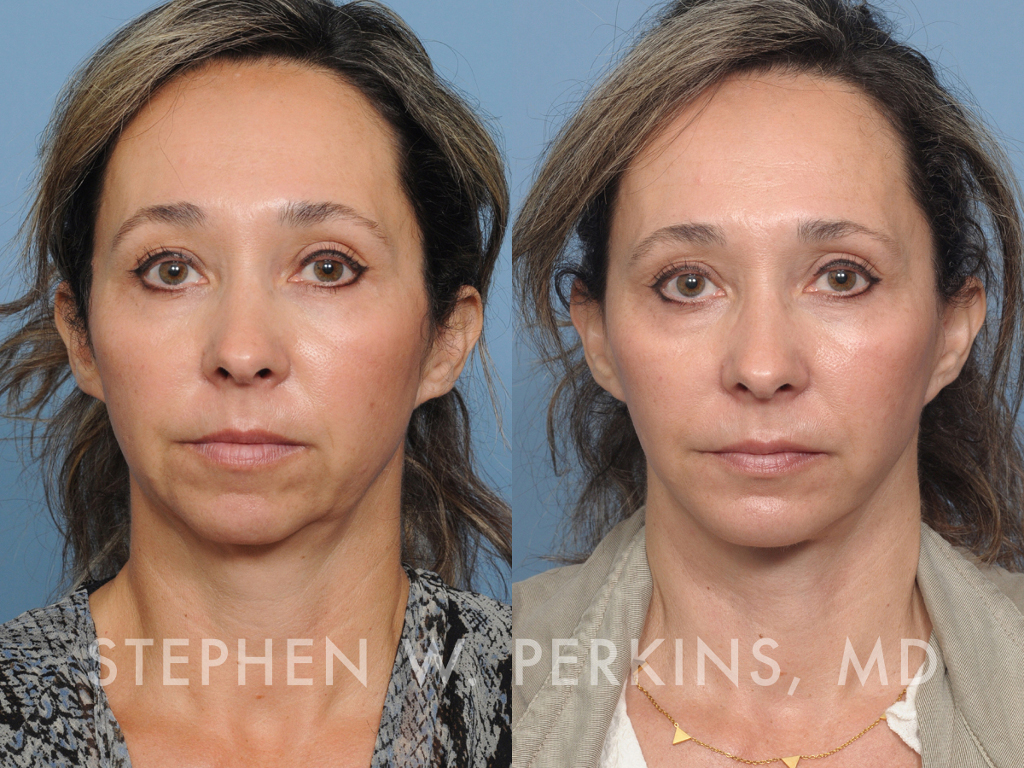 Indianapolis Plastic Surgeons | Dr. Stephen Perkins, MD QH04-front-1