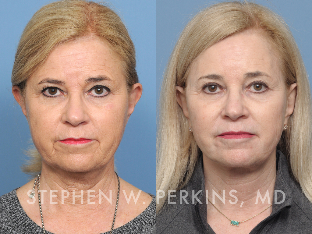 Indianapolis Facial Plastic Surgeons | Dr. Stephen Perkins, MD JB01-2