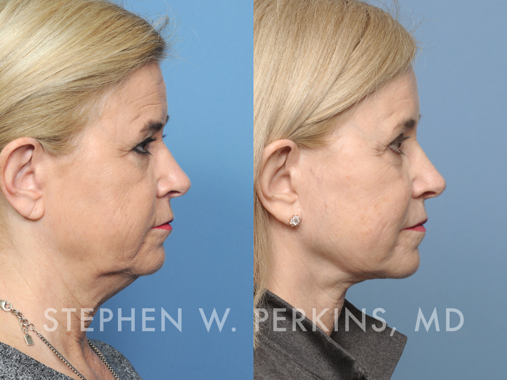 Indianapolis Facial Plastic Surgeons | Dr. Stephen Perkins, MD JB03