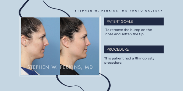 View Dr. Stephen Perkins Before and After Rhinoplasty Photos